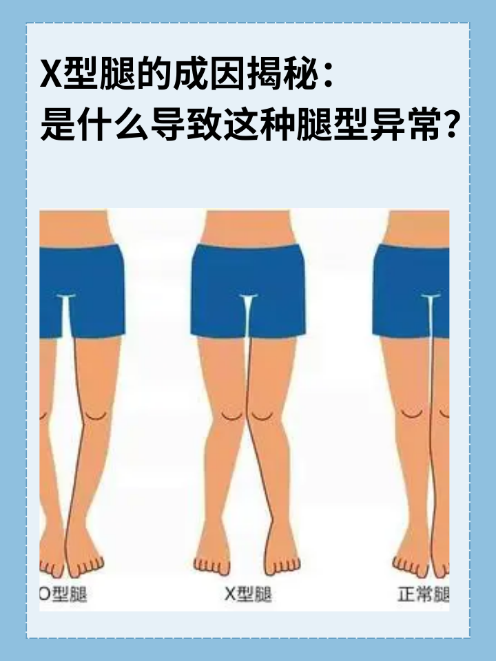 x型腿的成因揭秘:是什么导致这种腿型异常?