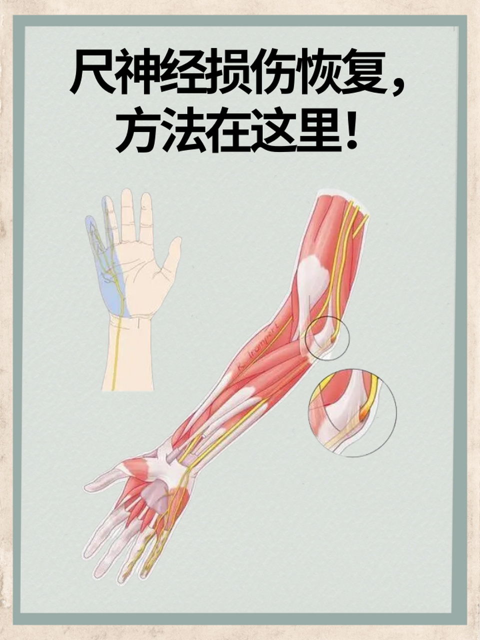 尺神经损伤后,恢复方法的选择至关重要.