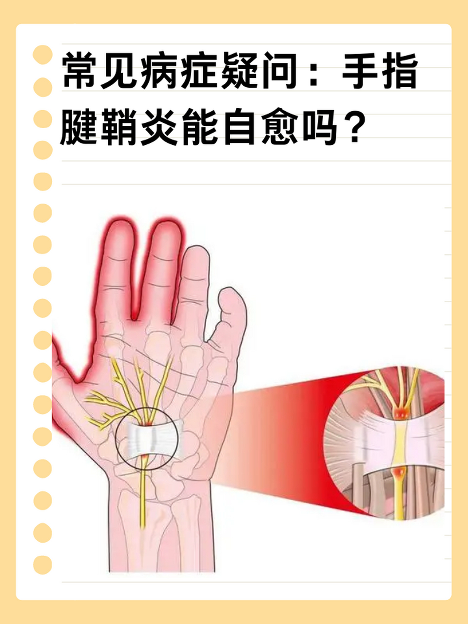 拇指屈指肌腱腱鞘炎图片