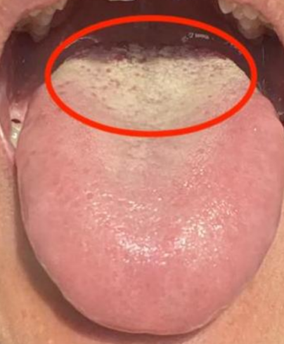 图片正常人舌头根部照片舌根正常人的舌根图片男性肾精亏虚舌头图片