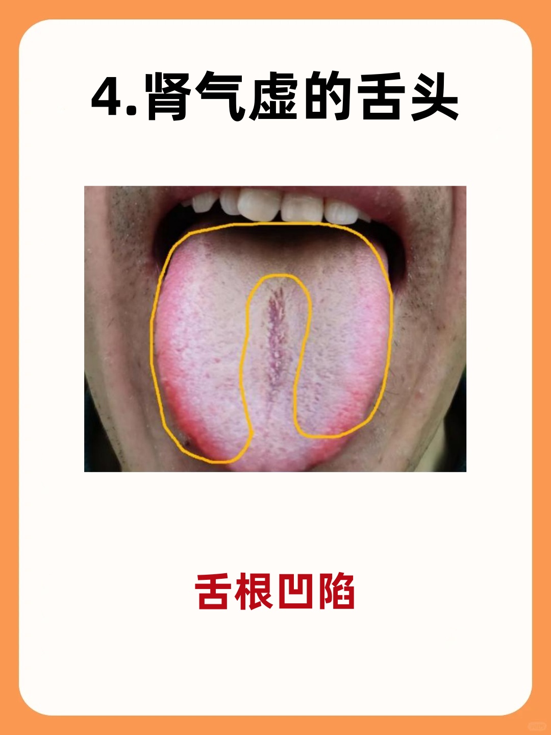 1健康的舌头 2肾阴虚的舌头 3肾阳虚的舌头 4