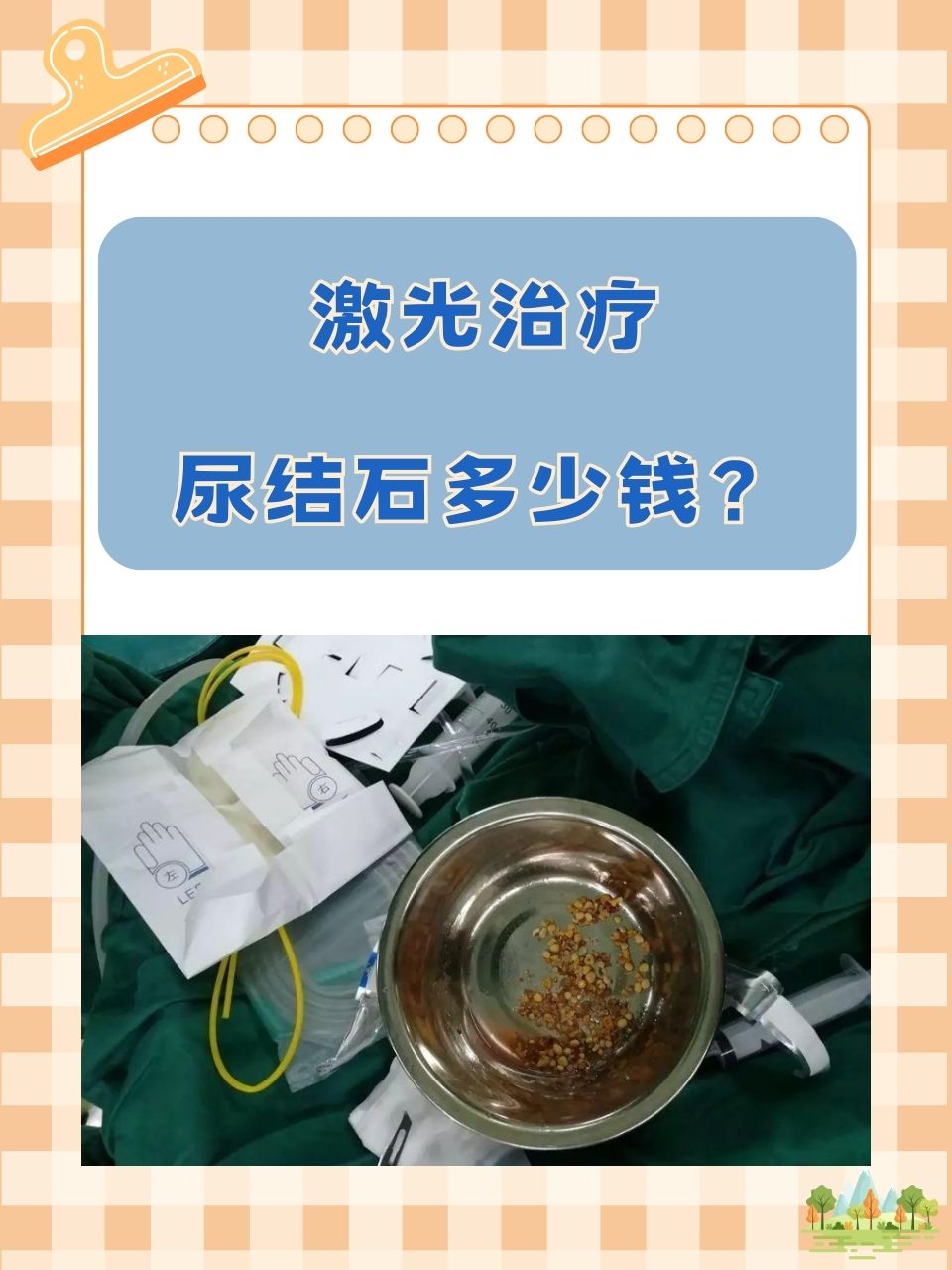 激光治疗尿结石多少钱