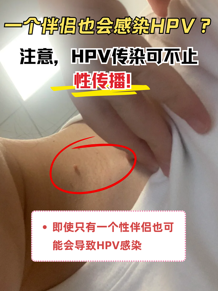 注意,hpv传染可不止性传播!