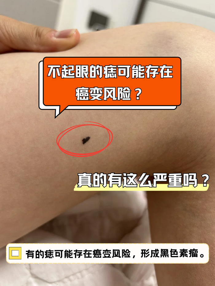 生活中常说的痣,一般指的是色素痣,是一种皮肤发育过程的异常表现