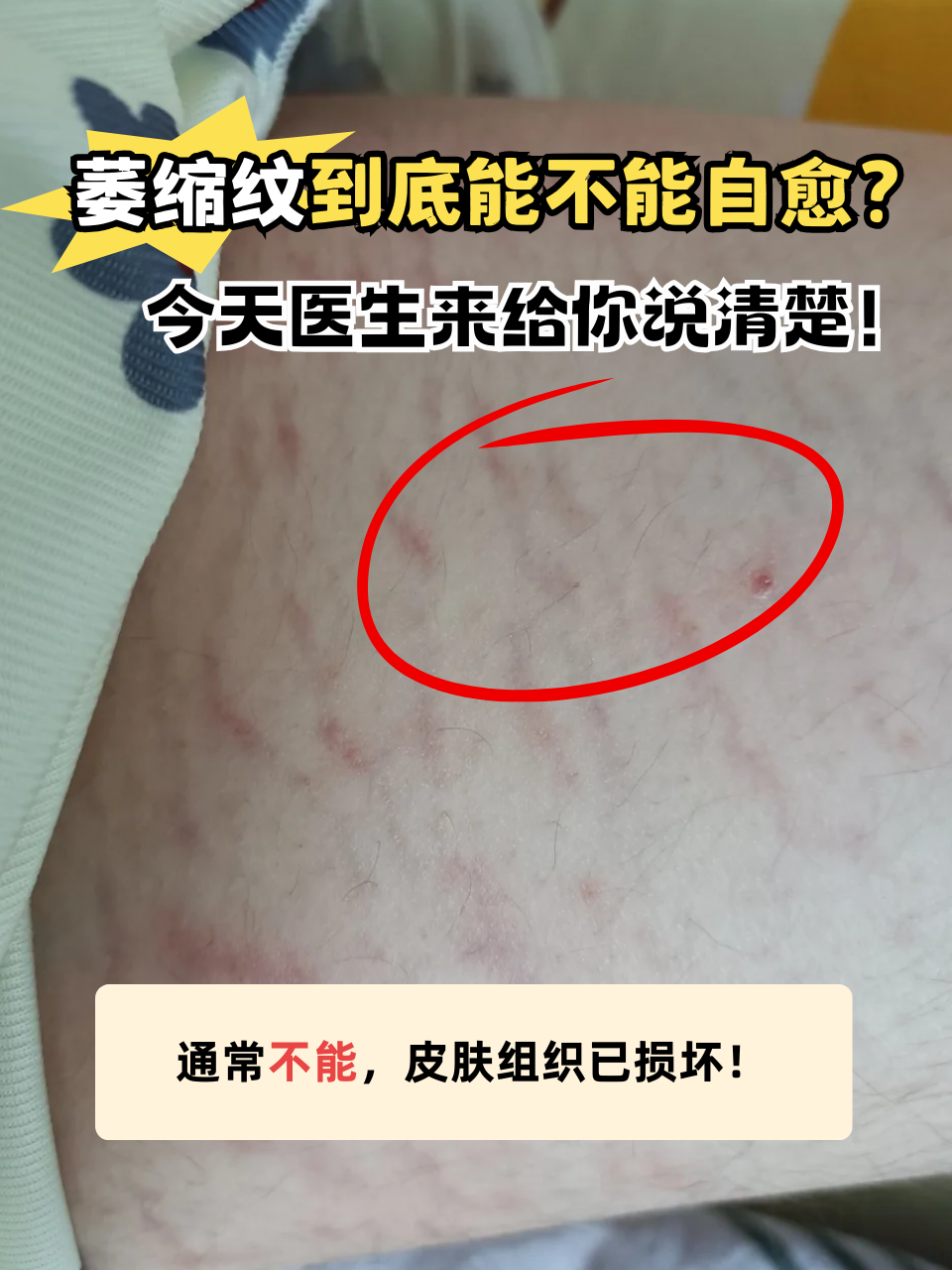 萎缩纹是一种皮肤上出现的条纹状萎缩变化,常见于青春期的快速发育