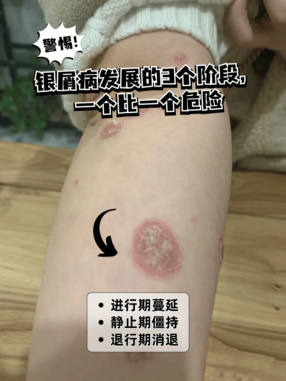 当心是银屑病找上门!