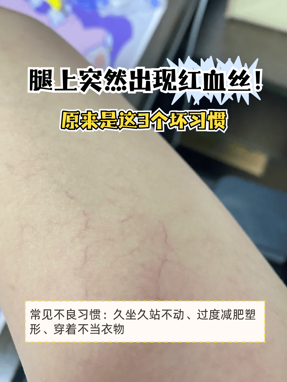 某天照镜子,突然发现腿上冒出红血丝,像小蜘蛛网