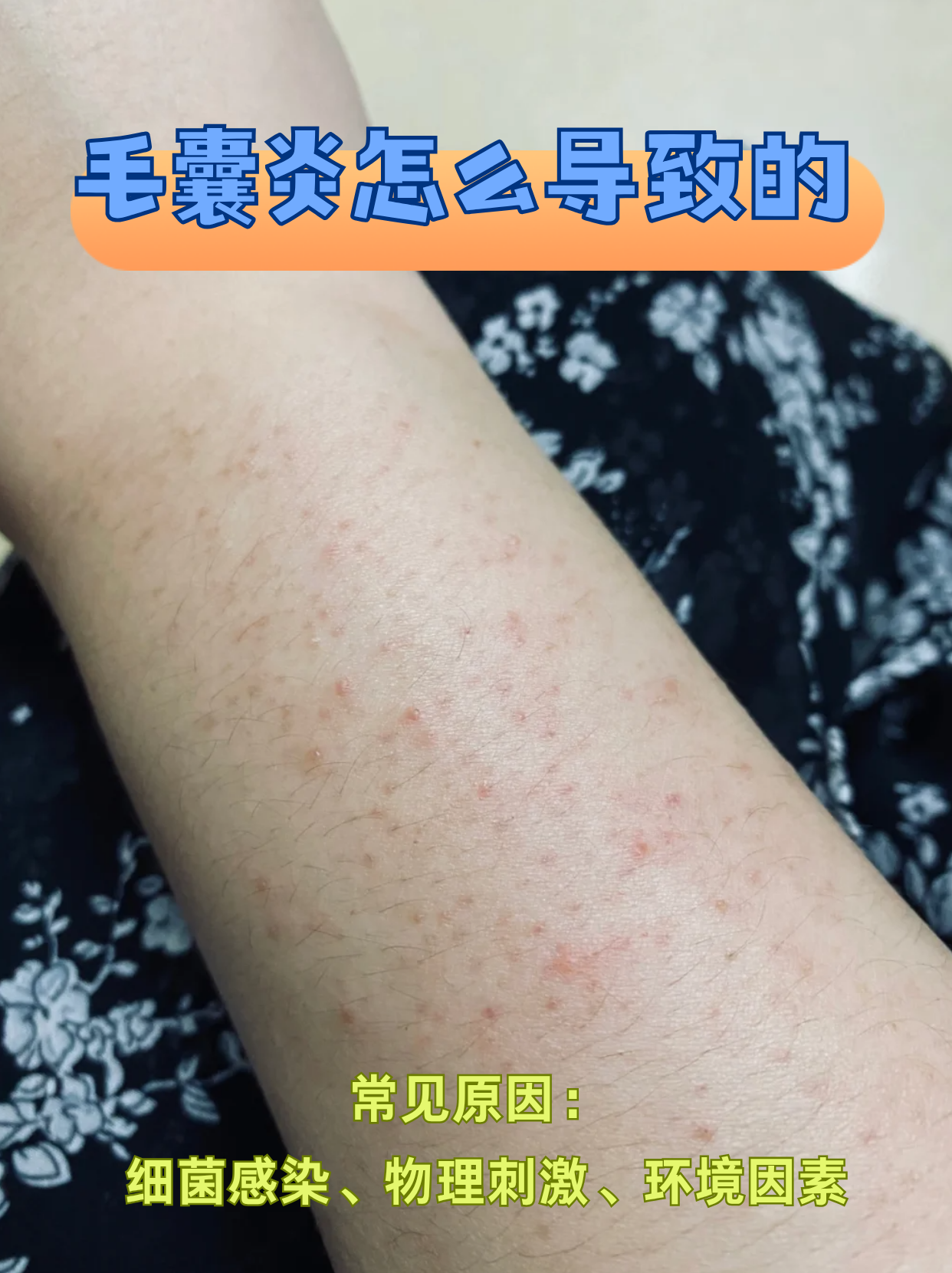 毛囊炎这个小麻烦,其实就像头发根部的"迷你火山