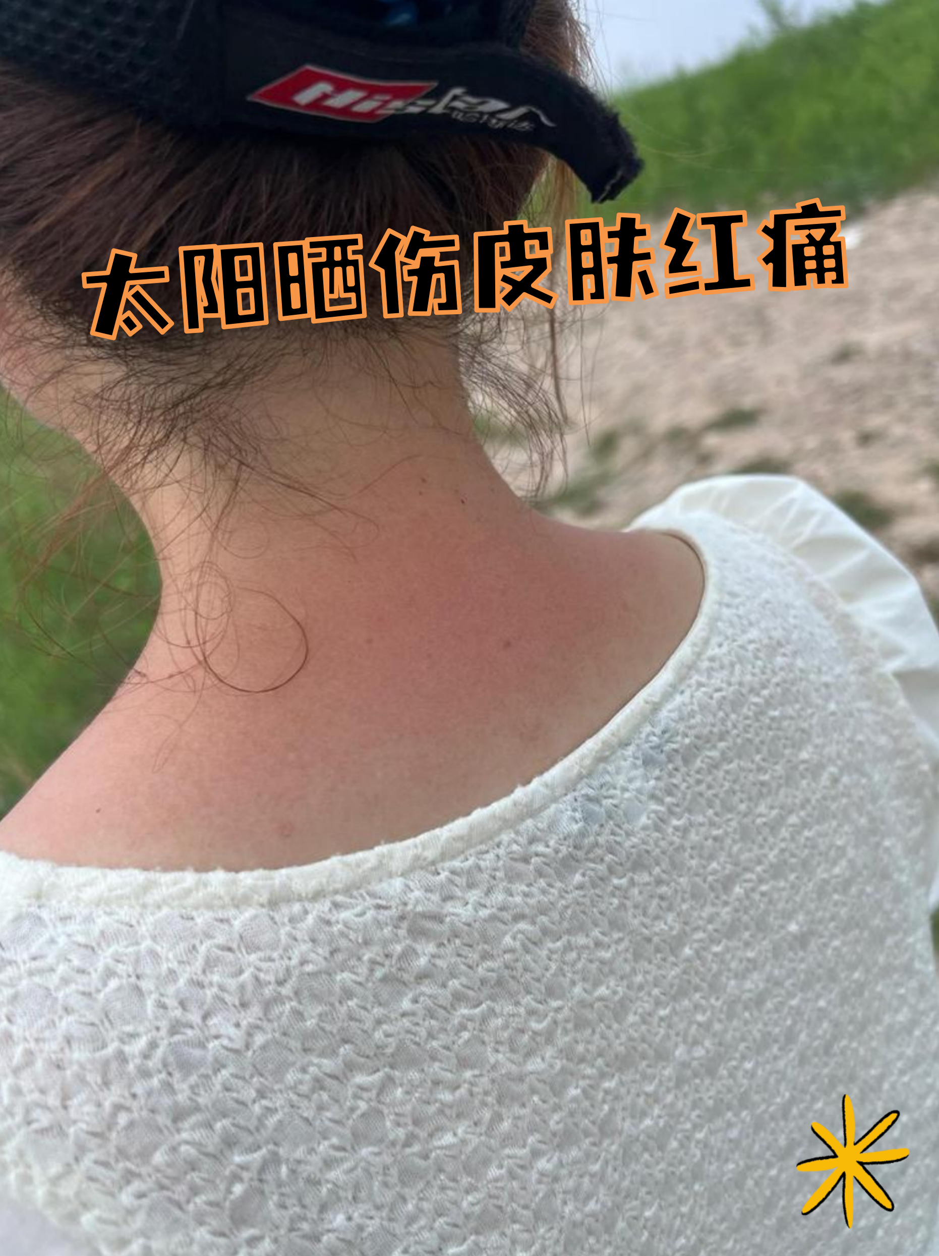 夏天阳光强烈,皮肤晒伤后出现红肿,刺痛是常见现象,这其实是紫外线对 