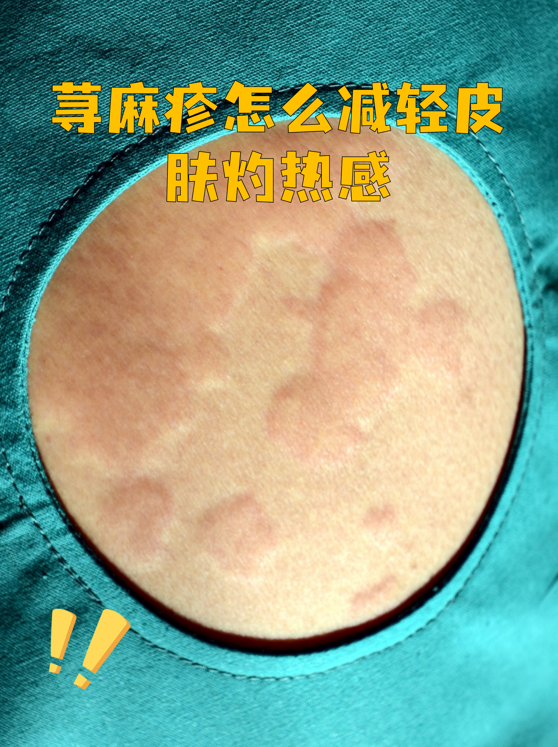 荨麻疹为什么冷水一冲就好了