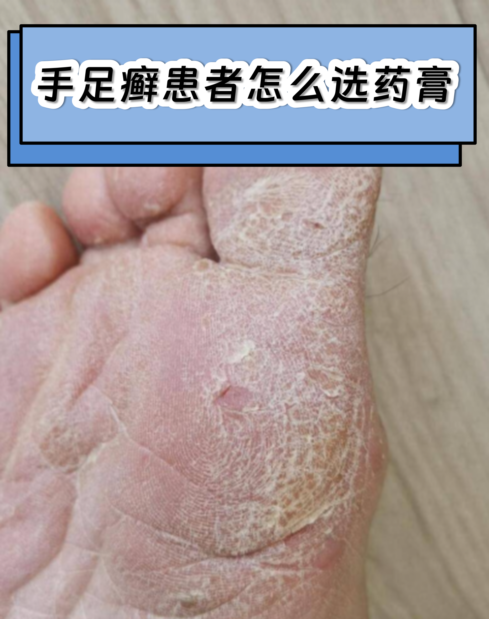 手足癣患者怎么选药膏