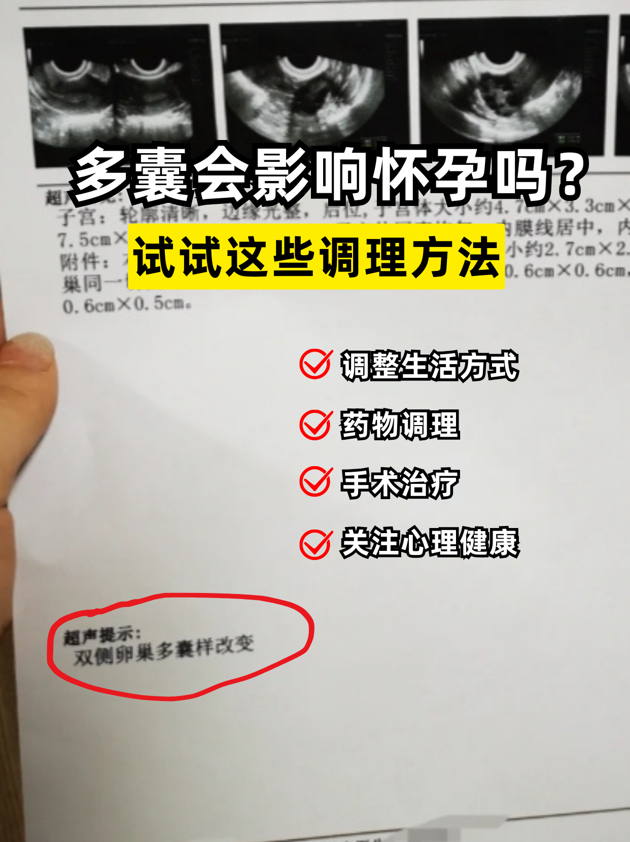 得了多囊能运动治疗吗(得了多囊能运动治疗吗女性)