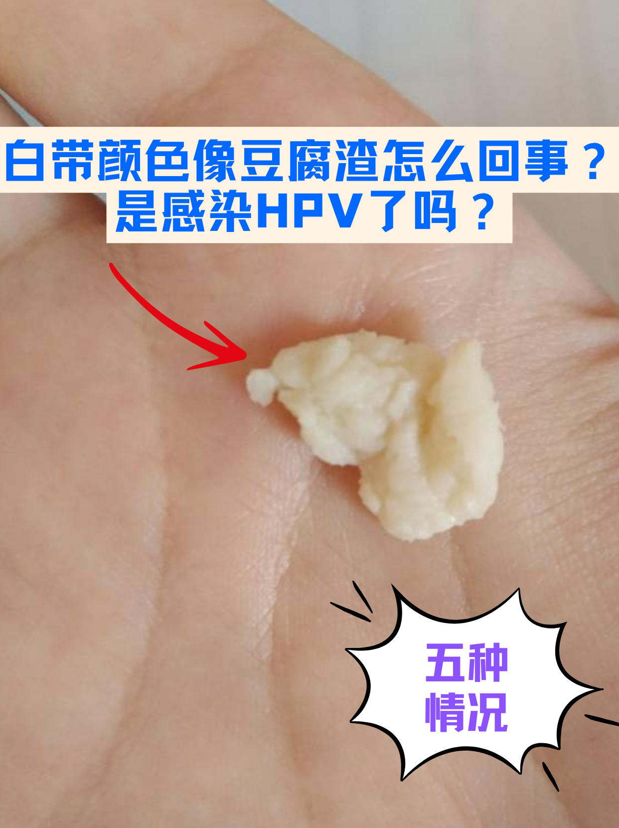 原来有这五种情况 白带颜色像豆腐渣,通常不是hpv感染的直接表现