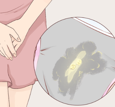 豆腐渣样白带是典型真菌感染表现,常见于免疫力下降或滥用抗生素后