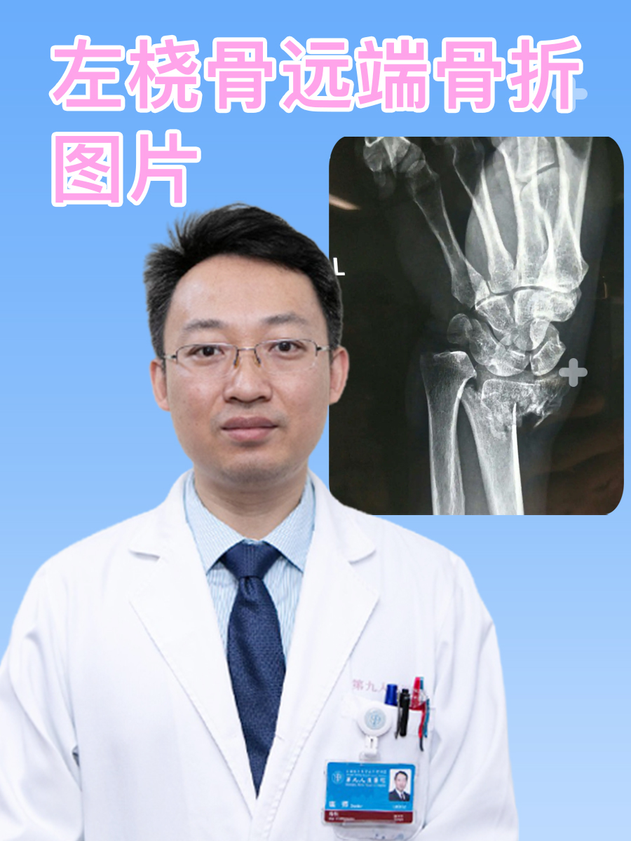 左桡骨远端骨折是手腕部位的常见骨折,它可能