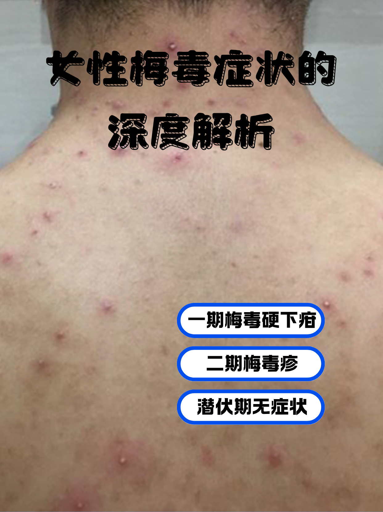 女性梅毒症状的深度解析