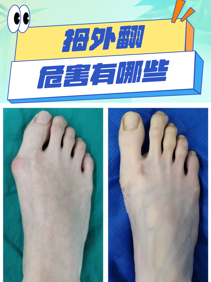 疼痛与畸形拇外翻患