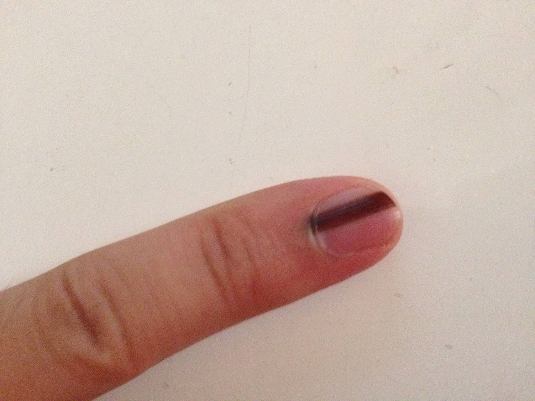 甲床上的黑线,医学上称之为甲黑线,常常是甲母痣的表现