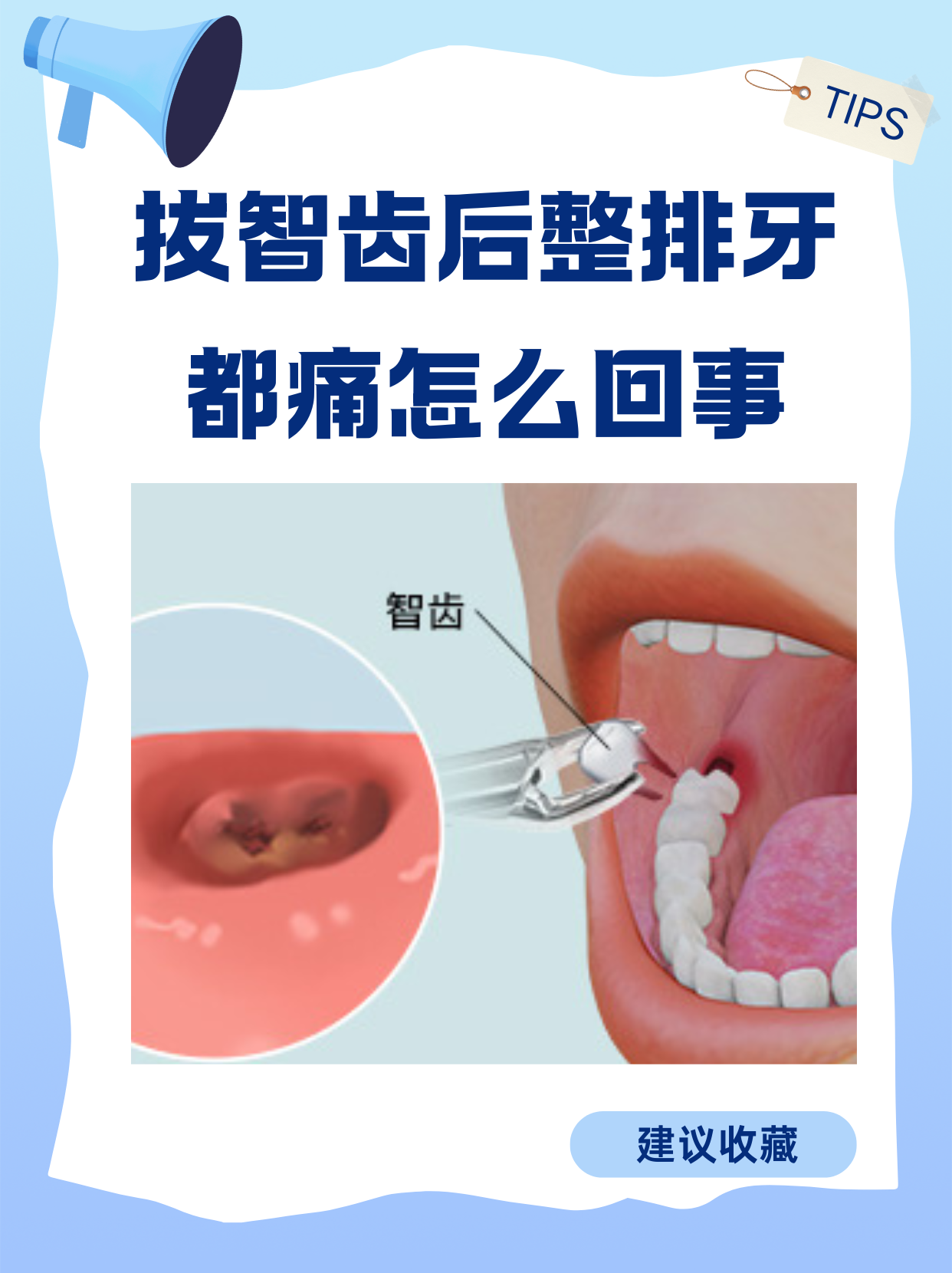 为什么智齿要拔