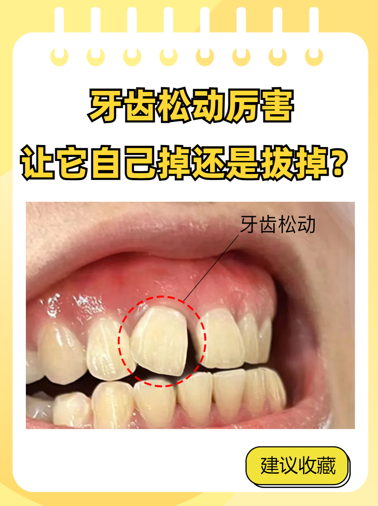 牙齿松动到连说话都打颤,是该"放手"让它自然脱落,还是主动寻求拔牙