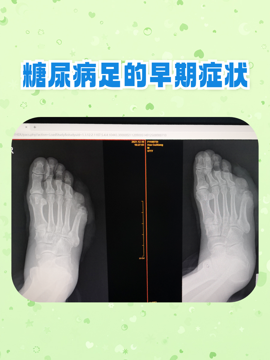 糖尿病足是糖尿病常见的慢性并发症,早期发现可