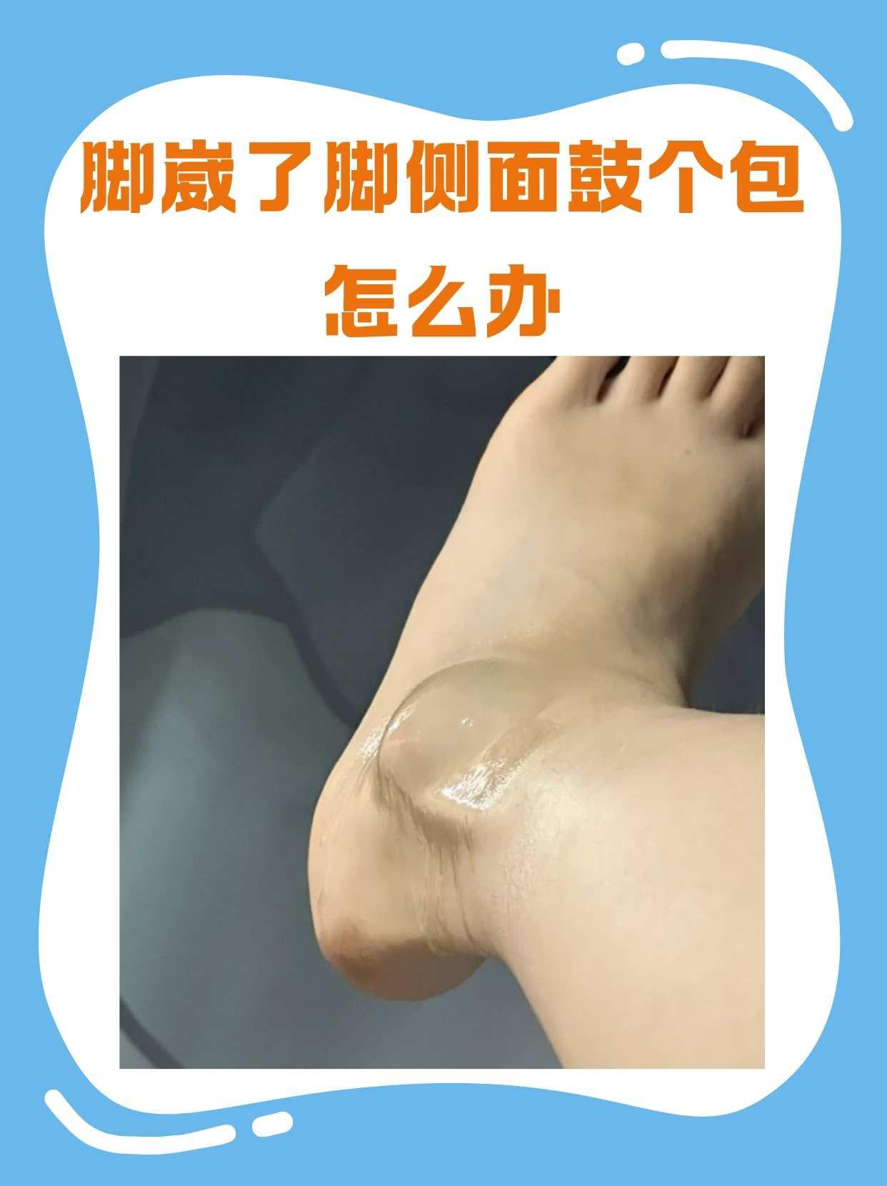 脚崴了脚侧面鼓个包怎么办 在日常生活中,脚崴伤是一种常见的意外情况