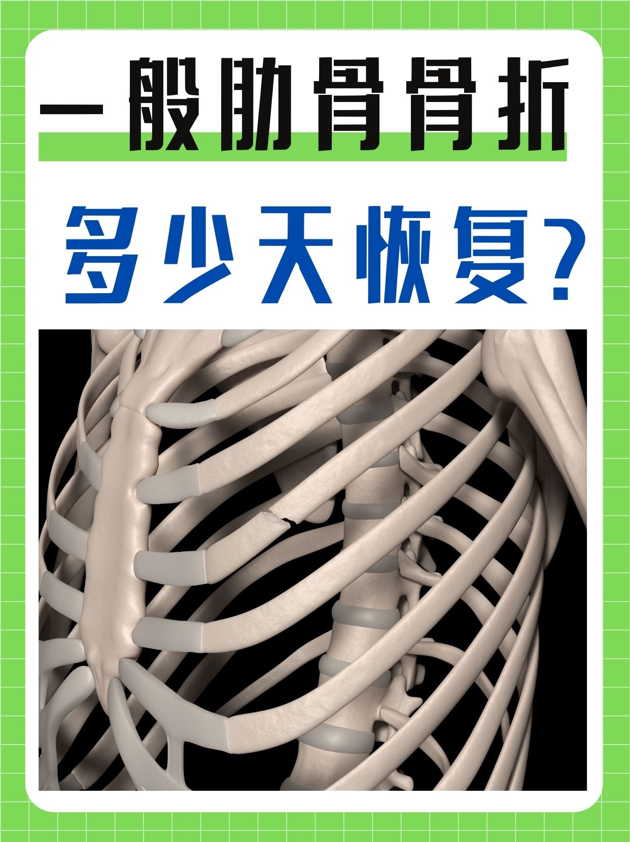 一般肋骨骨折多少天恢复 在日常生活中,不慎的跌倒,碰撞或是高强度的