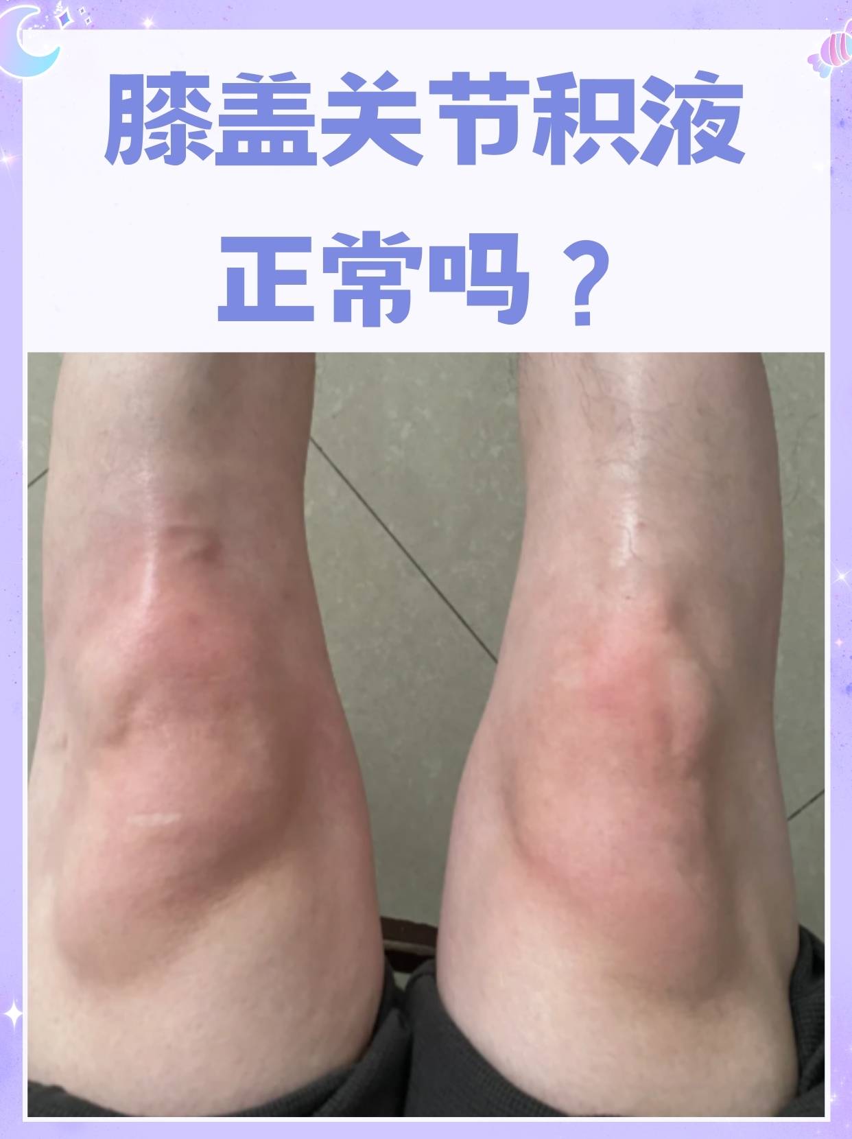 膝盖有关节积液正常吗 在探讨人体复杂的关节结构时,膝盖关节无疑是一