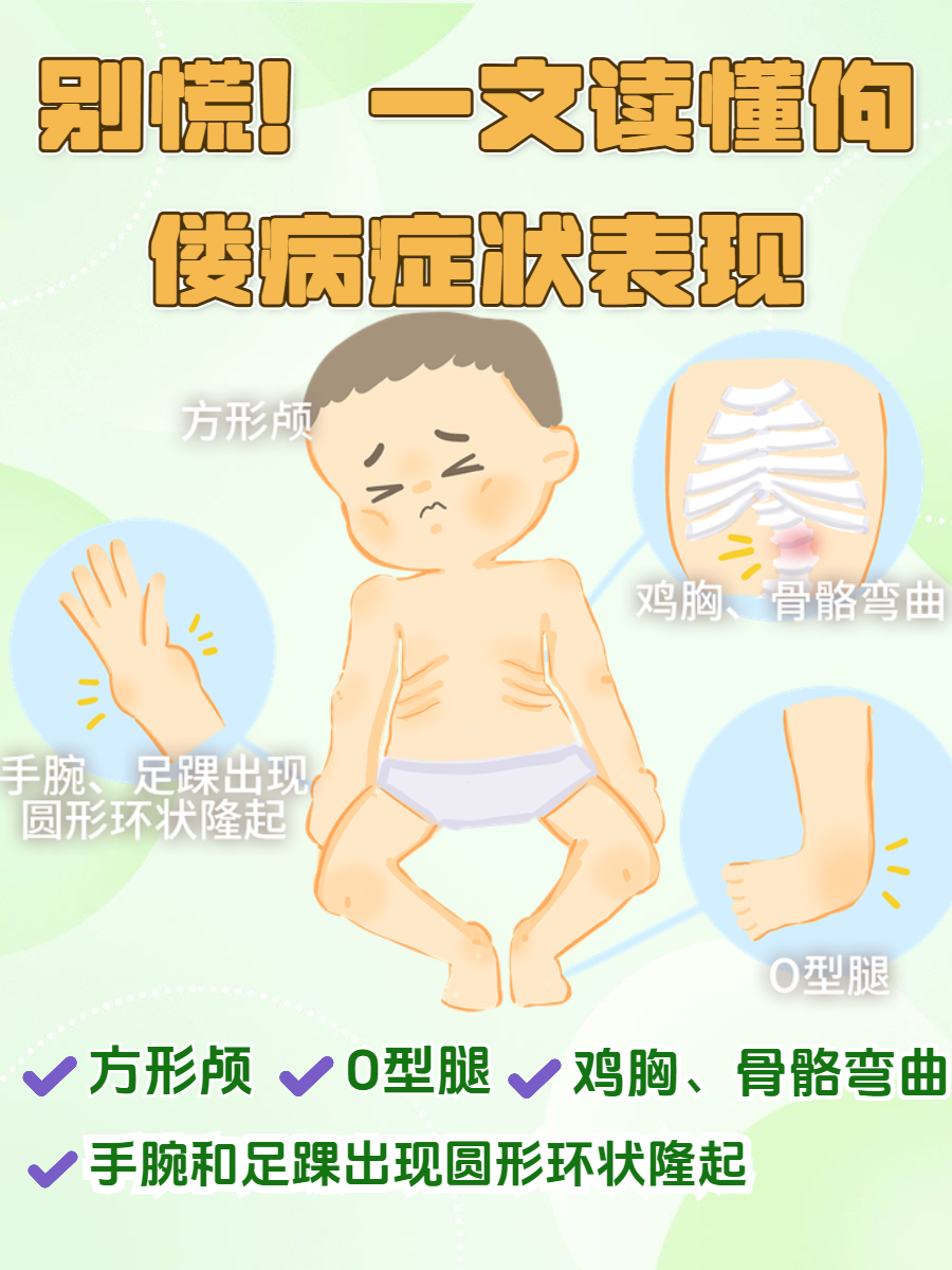 佝偻病症状图片维生素d缺乏性佝偻病佝偻病的图片早期儿童鸡胸的症状