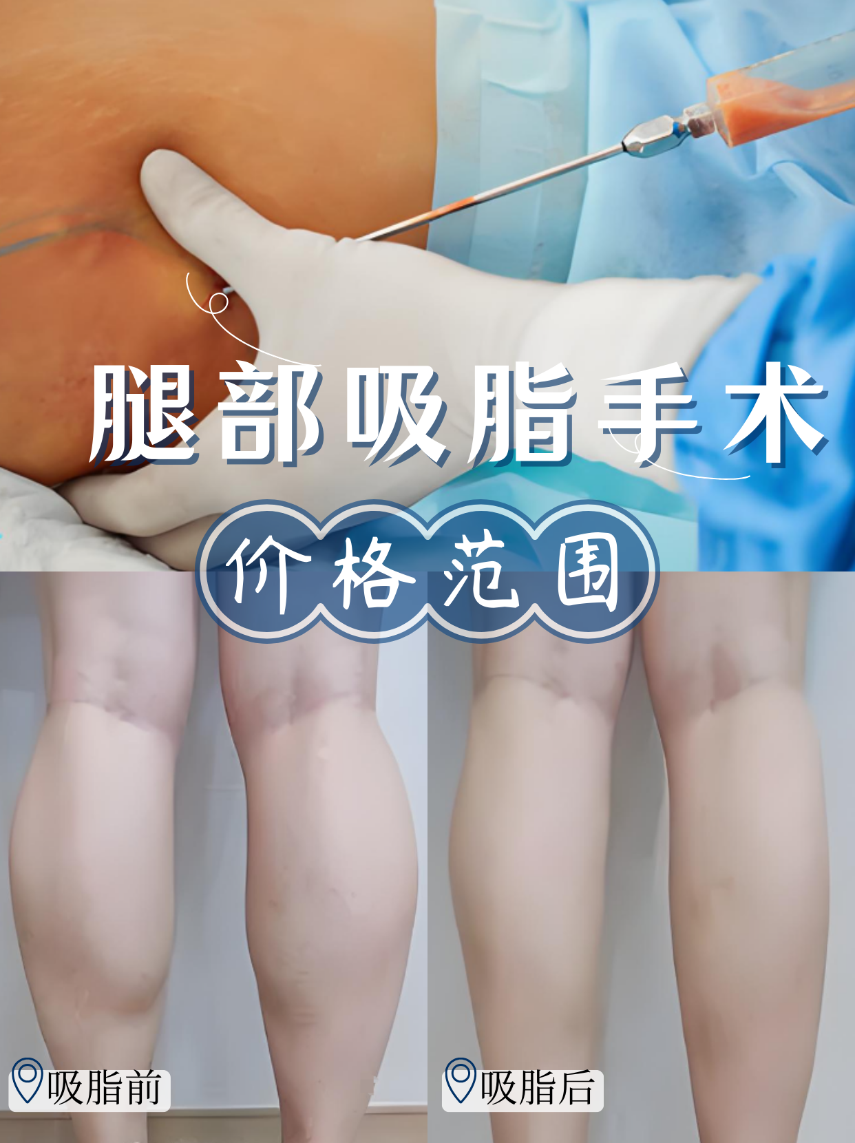 腿部吸脂手术的价格范围 常见的腿部吸脂方式有水动力吸脂,负压吸脂