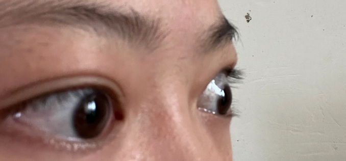 甲亢突眼常见的四种辨证类型
