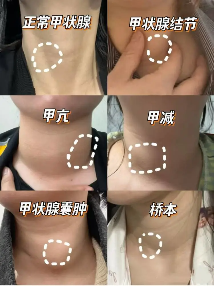 一次性讲清楚甲状腺的的问题!