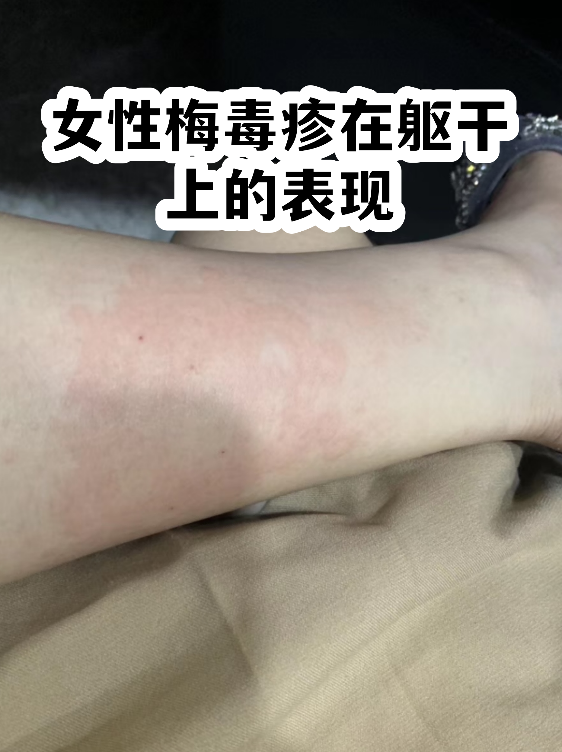 女性梅毒疹在躯干上的表现