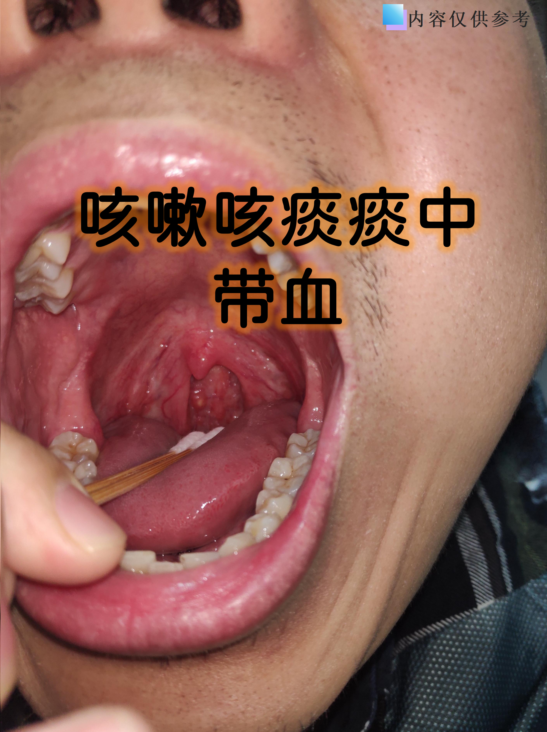 咳嗽咳痰时发现痰中带血确实会让人紧张,但不必