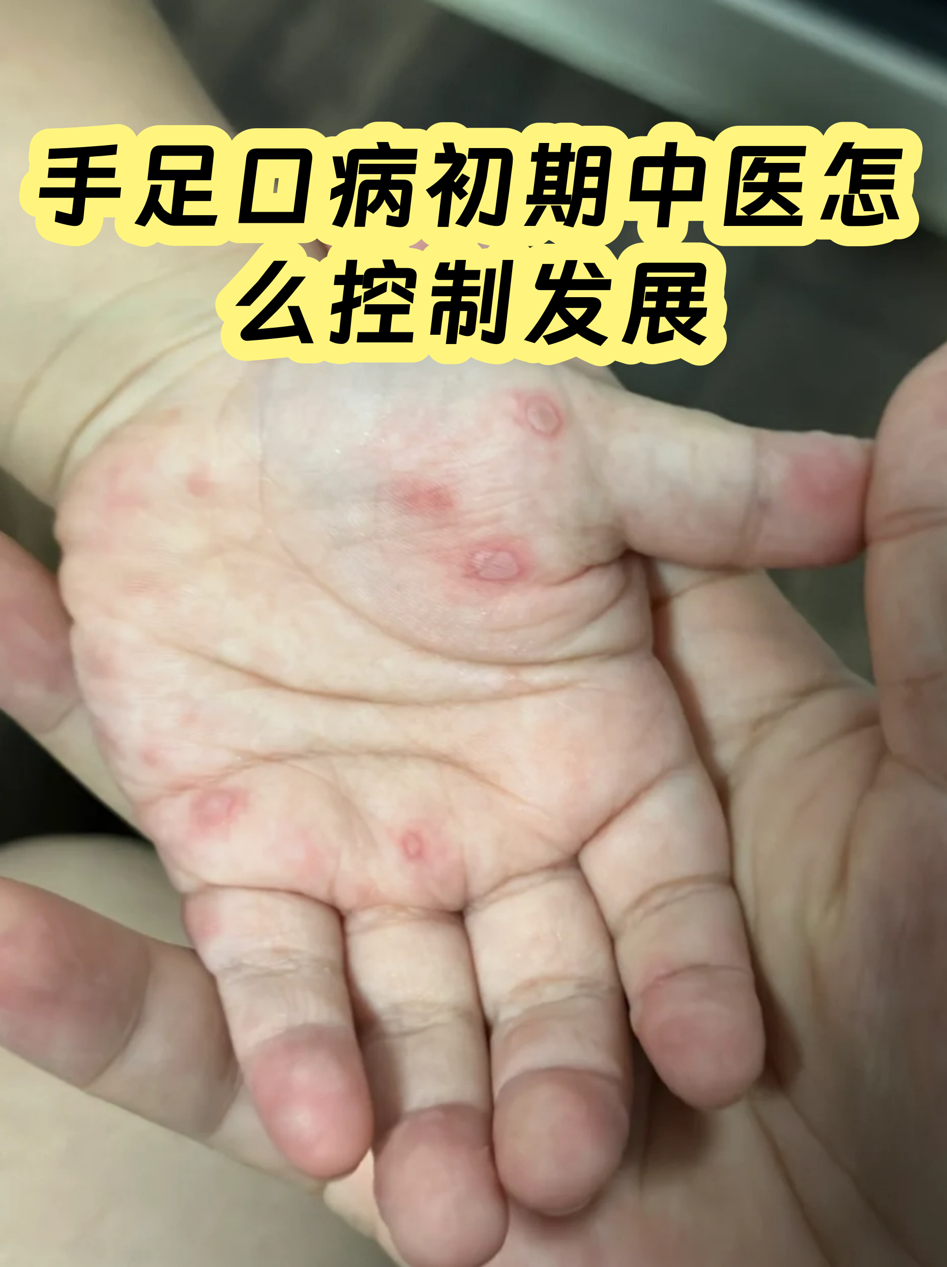 手机口病的症状 手机口病的症状
