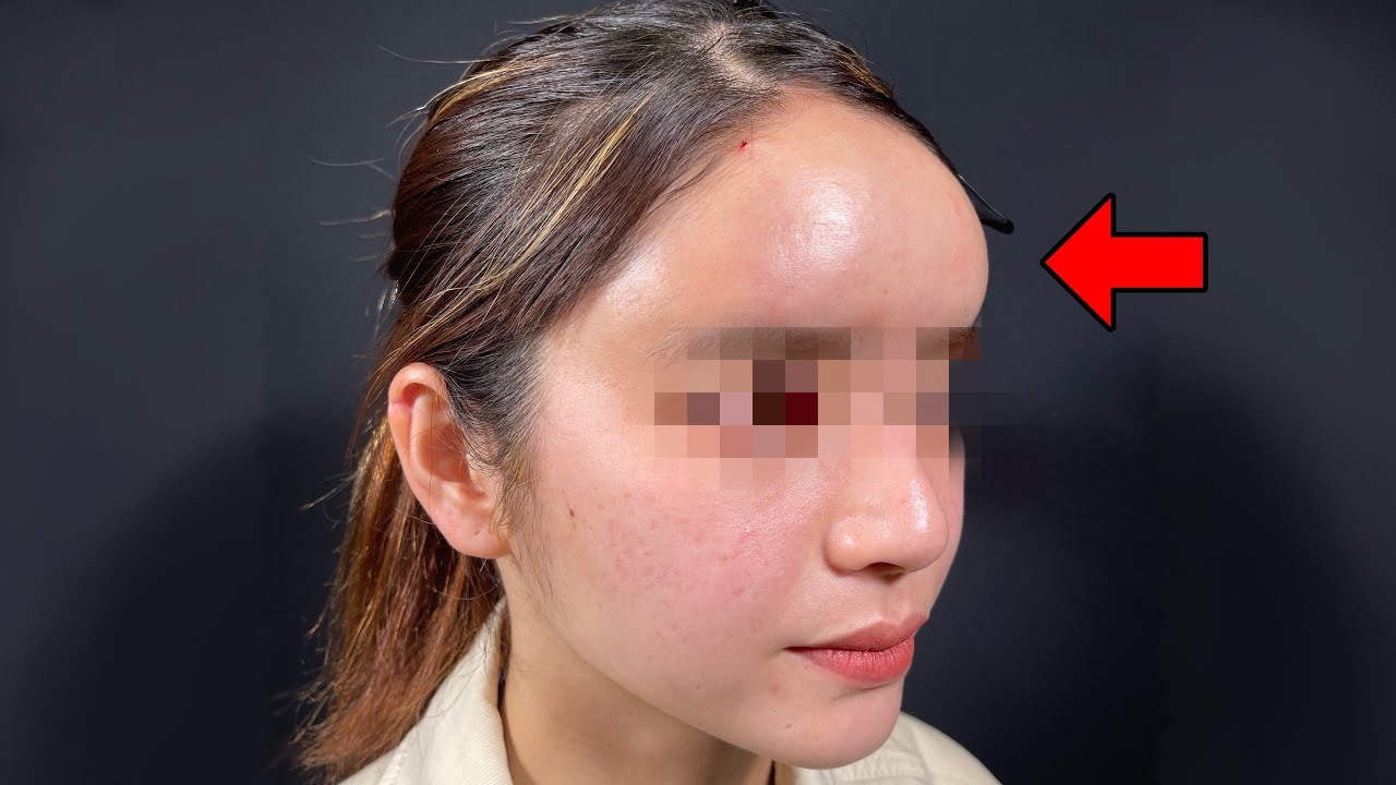 自体脂肪填充额头,是不是很容易变成网红脸? 不一定!