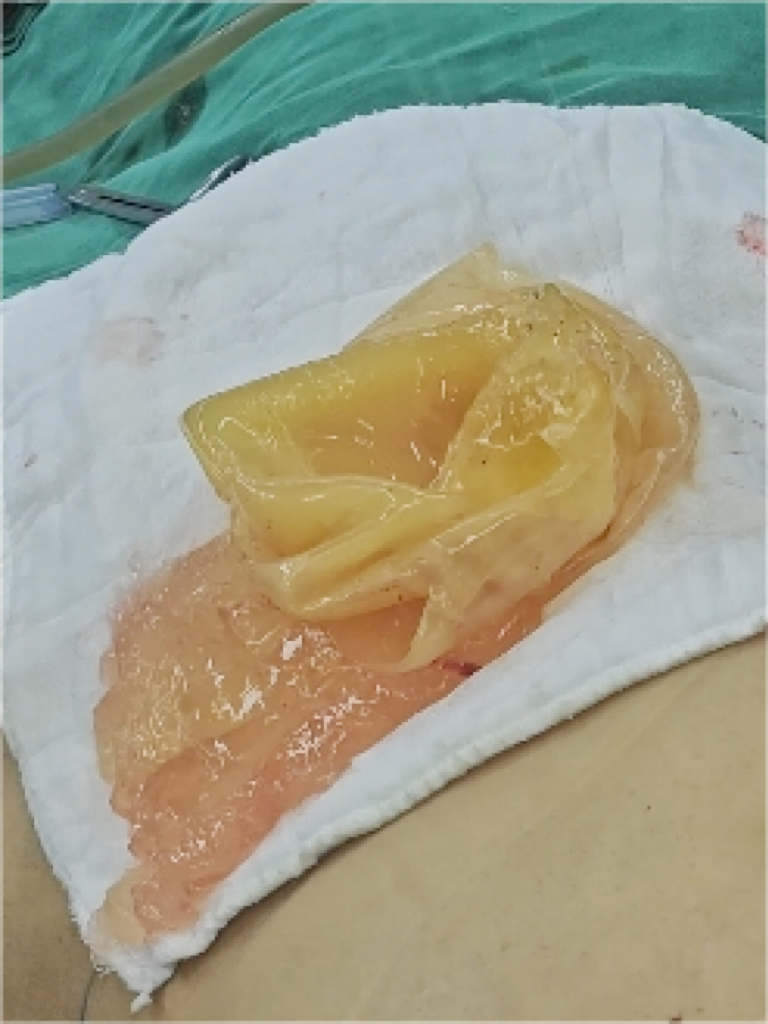 盐水假体破裂: 1,发生过程: 盐水袋破裂后,里面的无菌生理盐水会