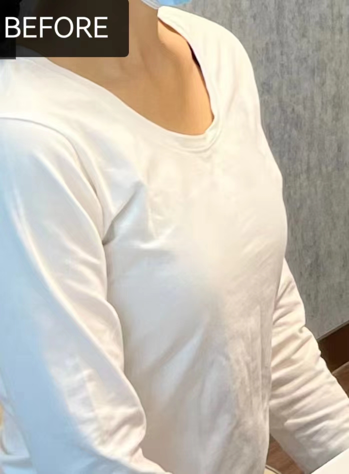 平胸了30多年,做完脂肪丰胸终于有胸了!