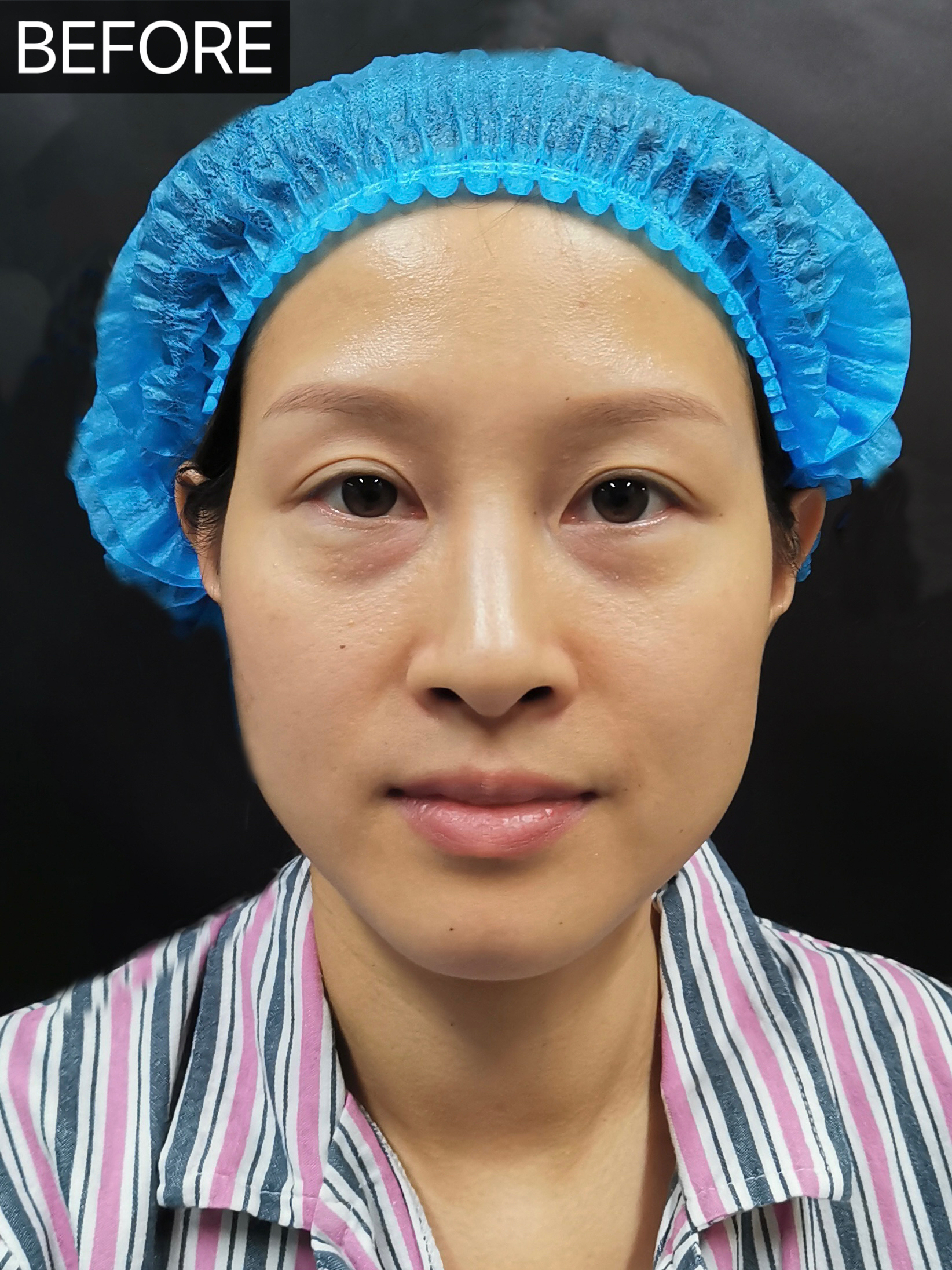 从苦相脸→妈生幼态脸,看看她的变化有多惊艳!