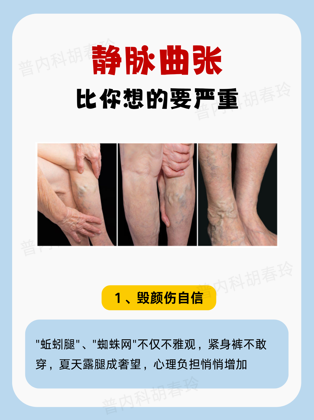 静脉曲张到底有多严重?别再觉得无所谓了!