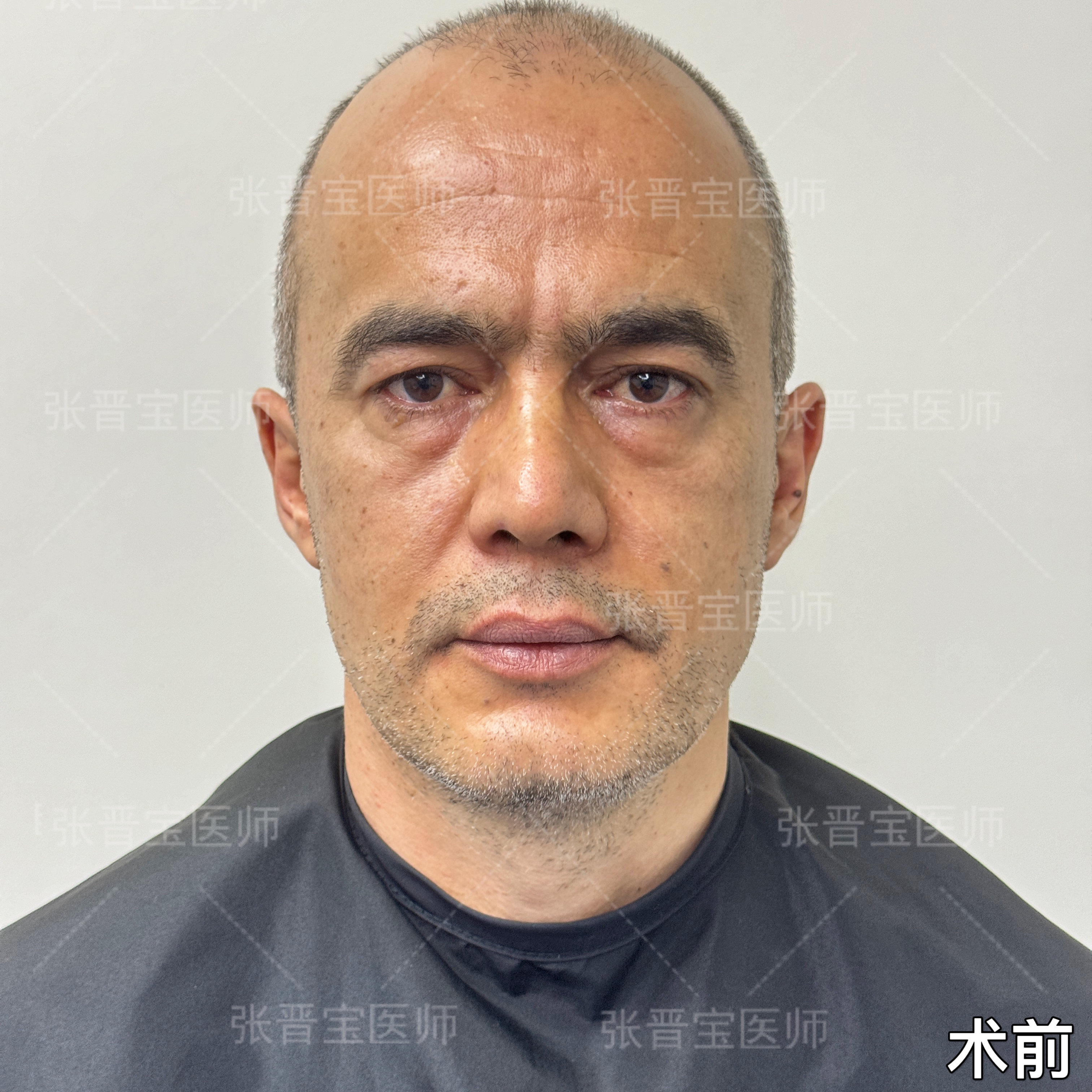 这位男士今年47岁,眼袋和泪沟的问题一直困扰着他,不