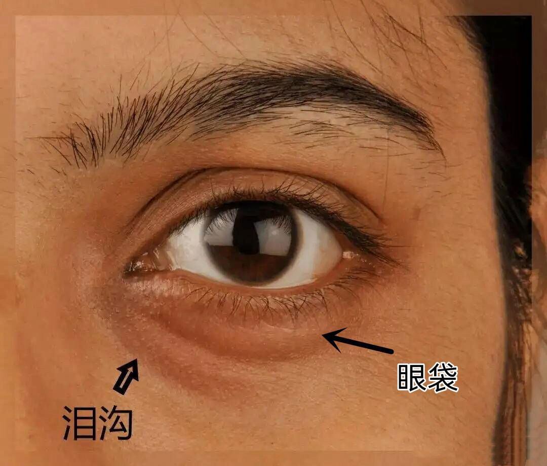 为什么会有泪沟形成为什么在线