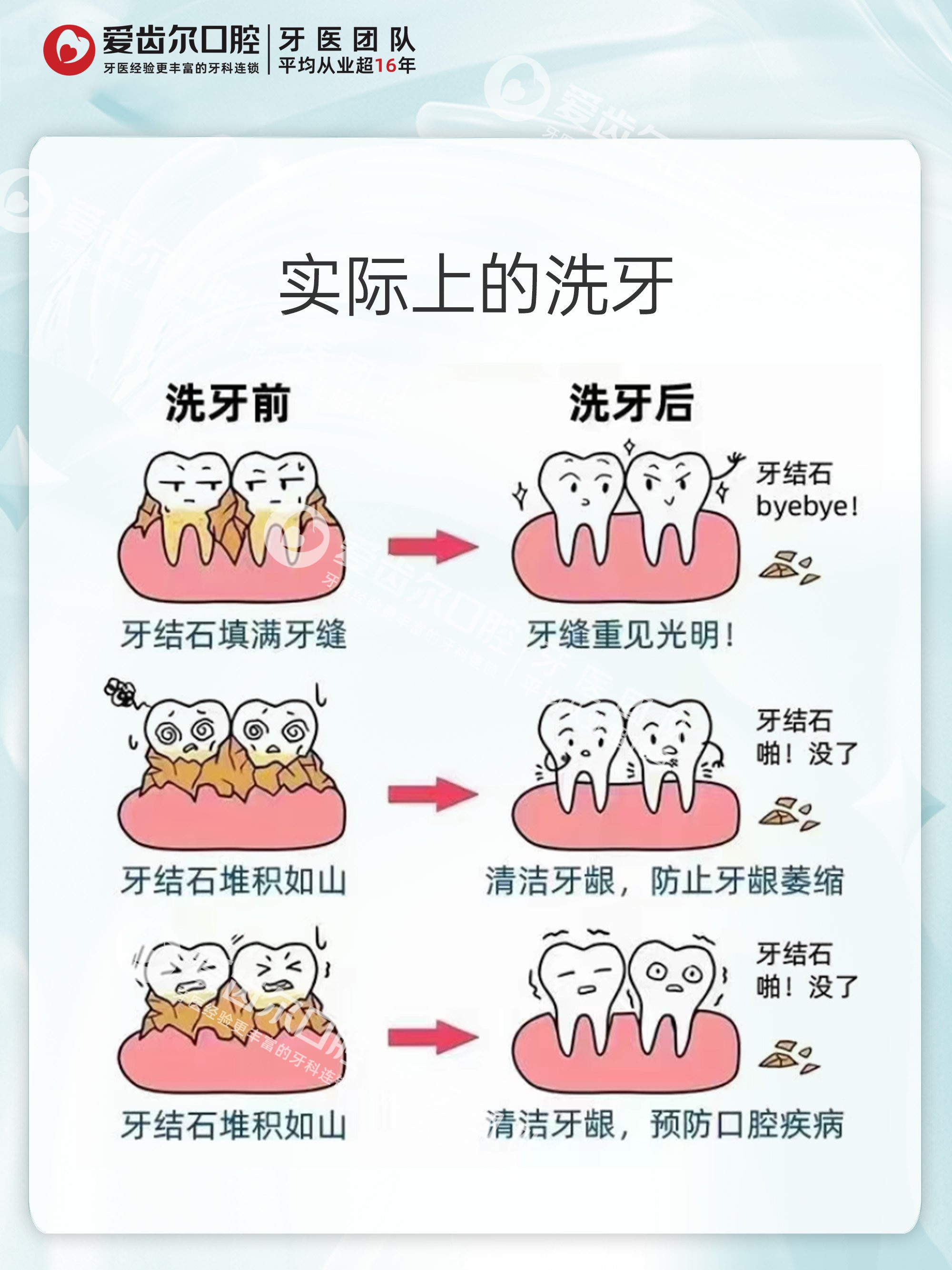 为什么天天刷牙还有牙结石和牙菌斑百科在线