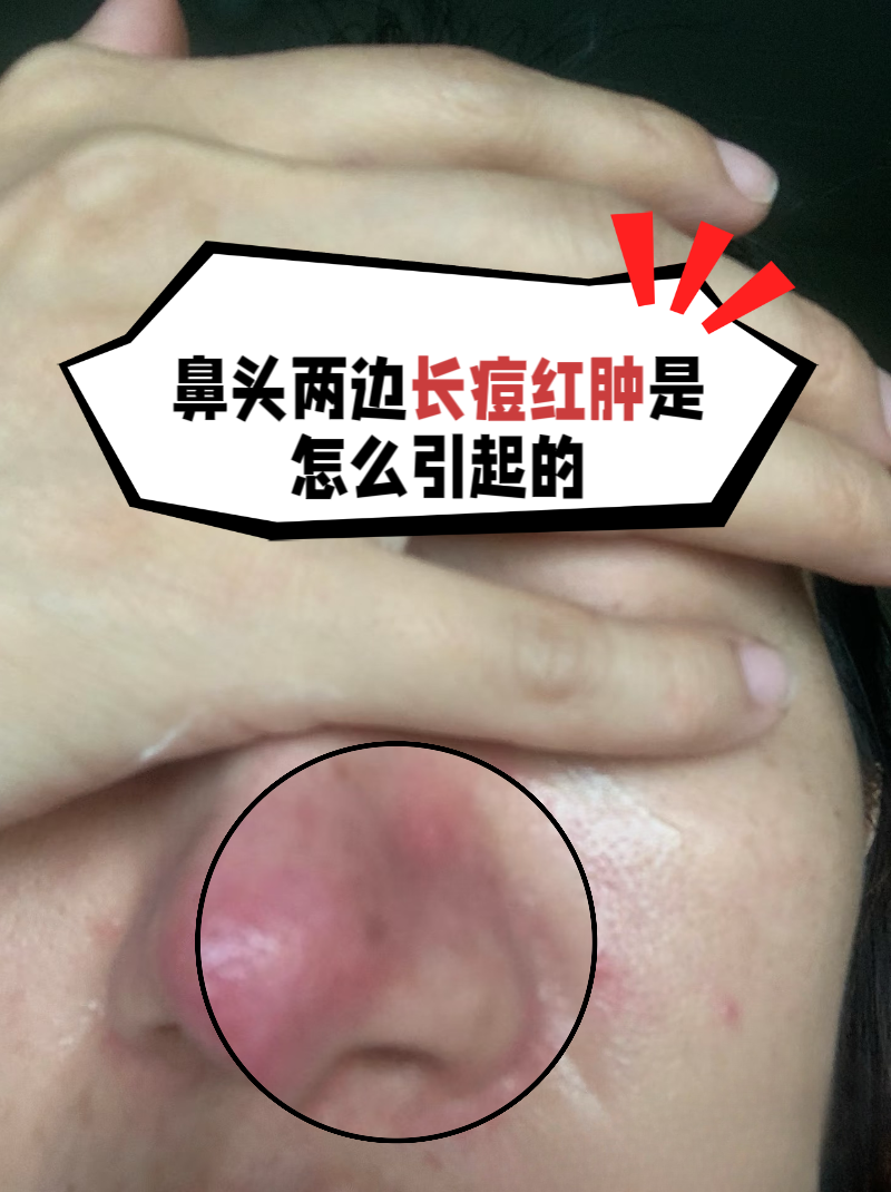 鼻头两边长痘红肿是怎么引起的