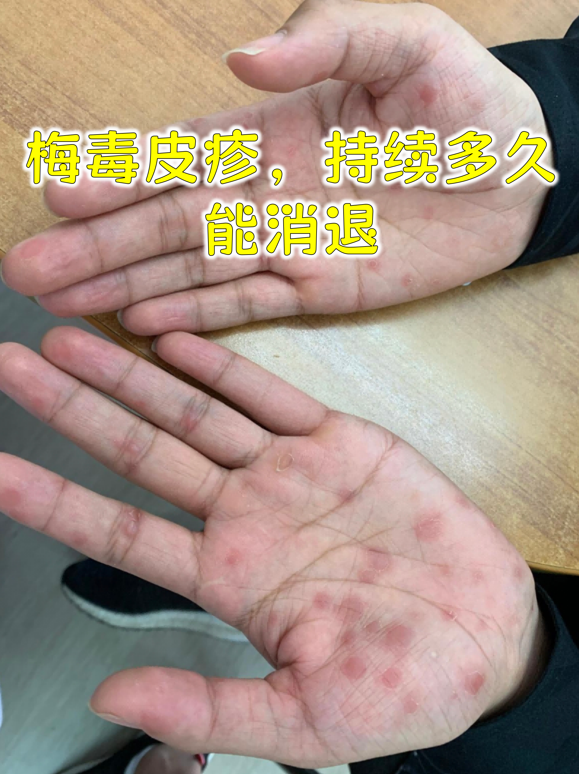 这种皮肤表现是二期梅毒的典型症状,及时治疗是关键