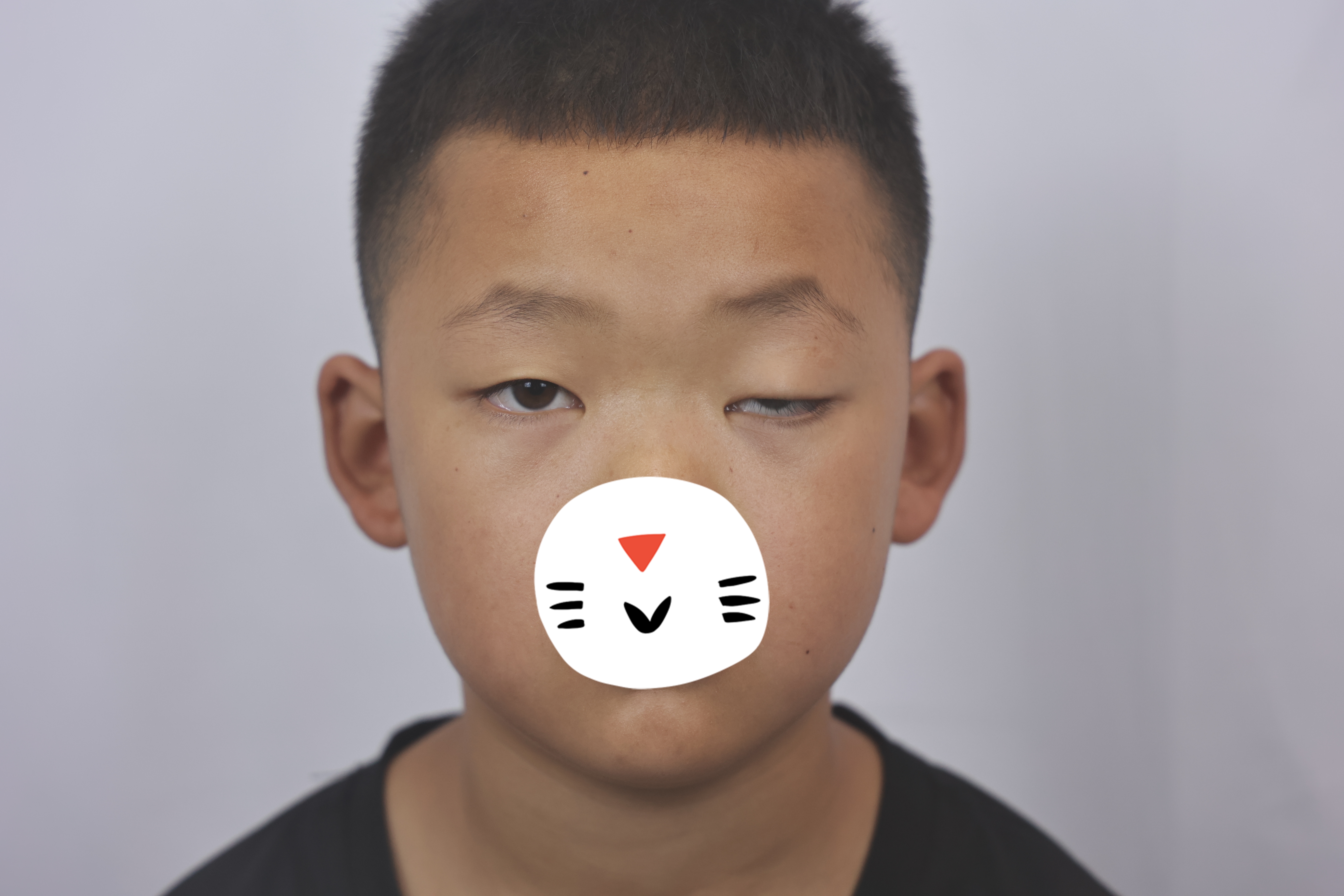 了一个很懂事的孩子,孩子今年9岁,单侧先天性上睑下垂,大小眼特别明显
