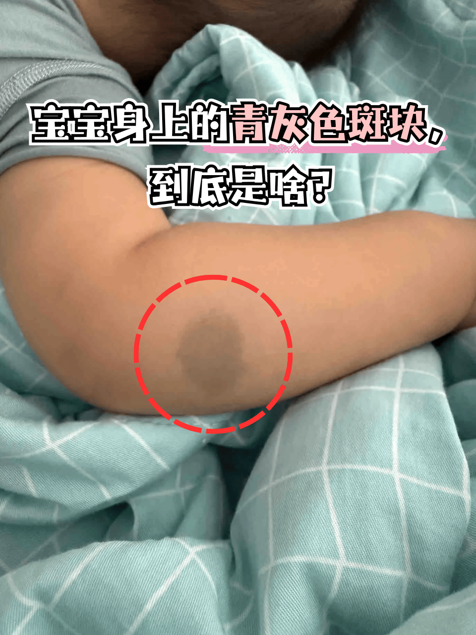 新手爸妈看到宝宝身上的青灰色斑块是不是慌了神?别担心!