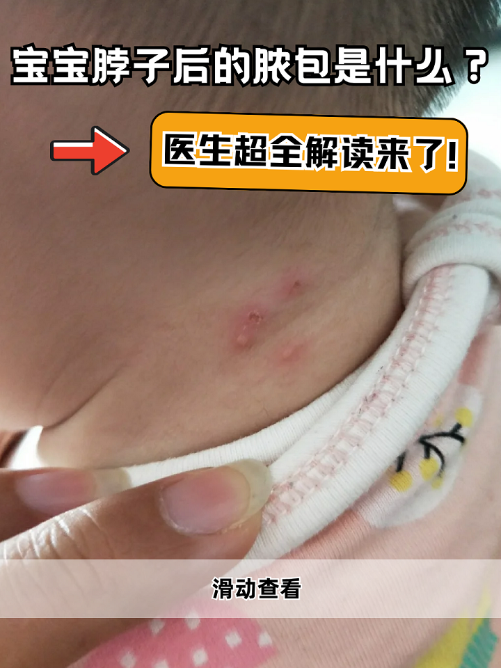 宝宝脖子后面的脓包是什么 毛囊炎 疖肿 痈