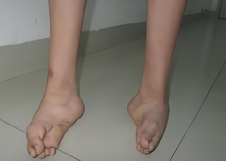 小儿麻痹后遗症是什么