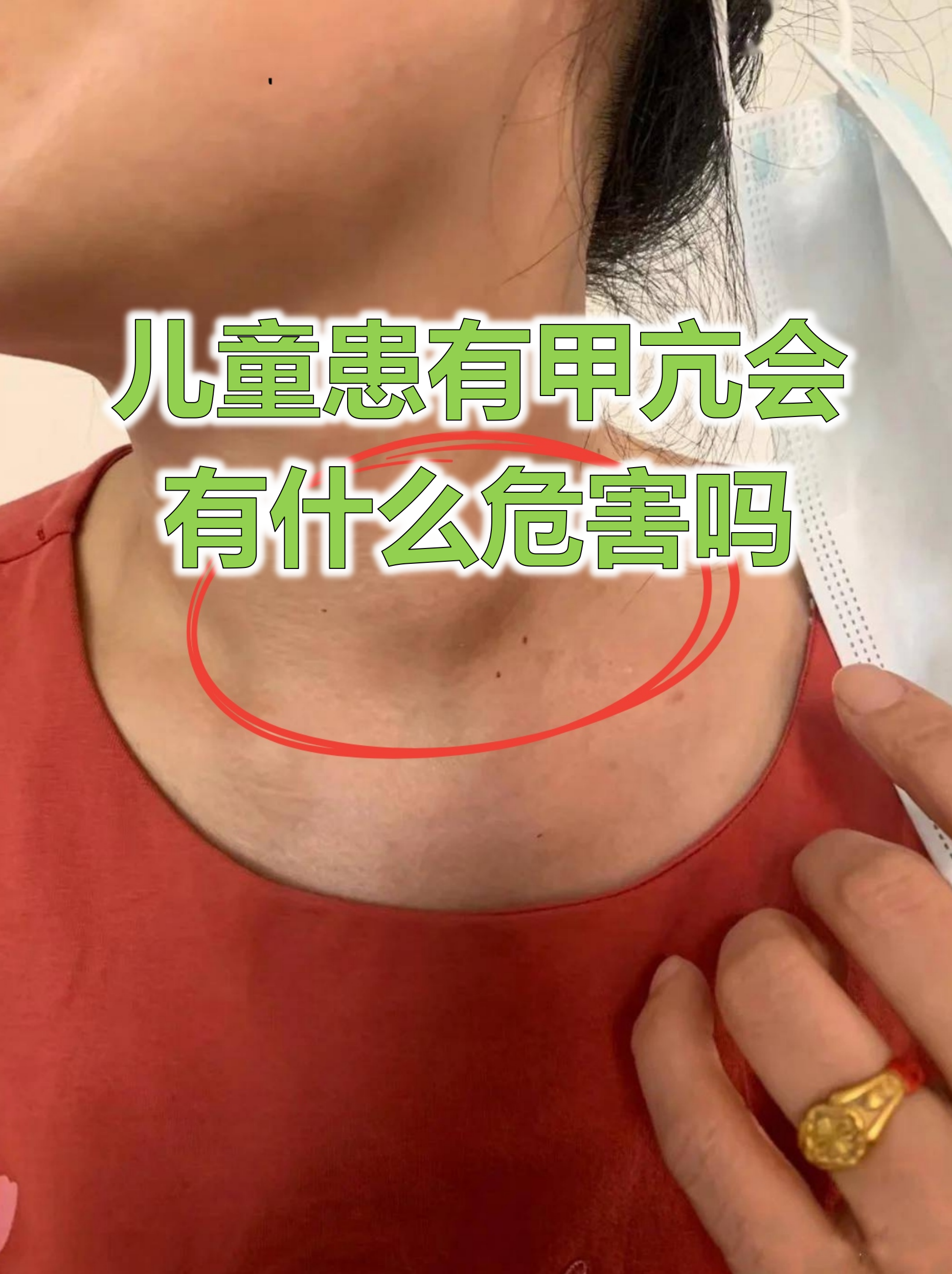 儿童患有甲亢会有什么危害吗